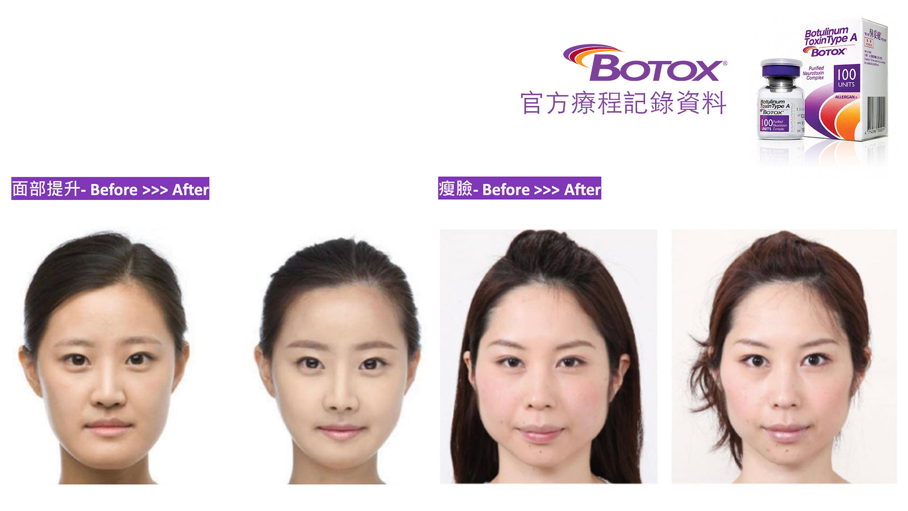 官方療程記錄中的面部 BOTOX 注射前後效果比較。左側為治療前,患者面部表情僵硬、咀嚼肌與額頭較緊張;右側為注射後,臉型變得更自然柔和,咀嚼肌與額頭線條放鬆,整體面部輪廓變立體並略微收緊,達至瘦面效果。