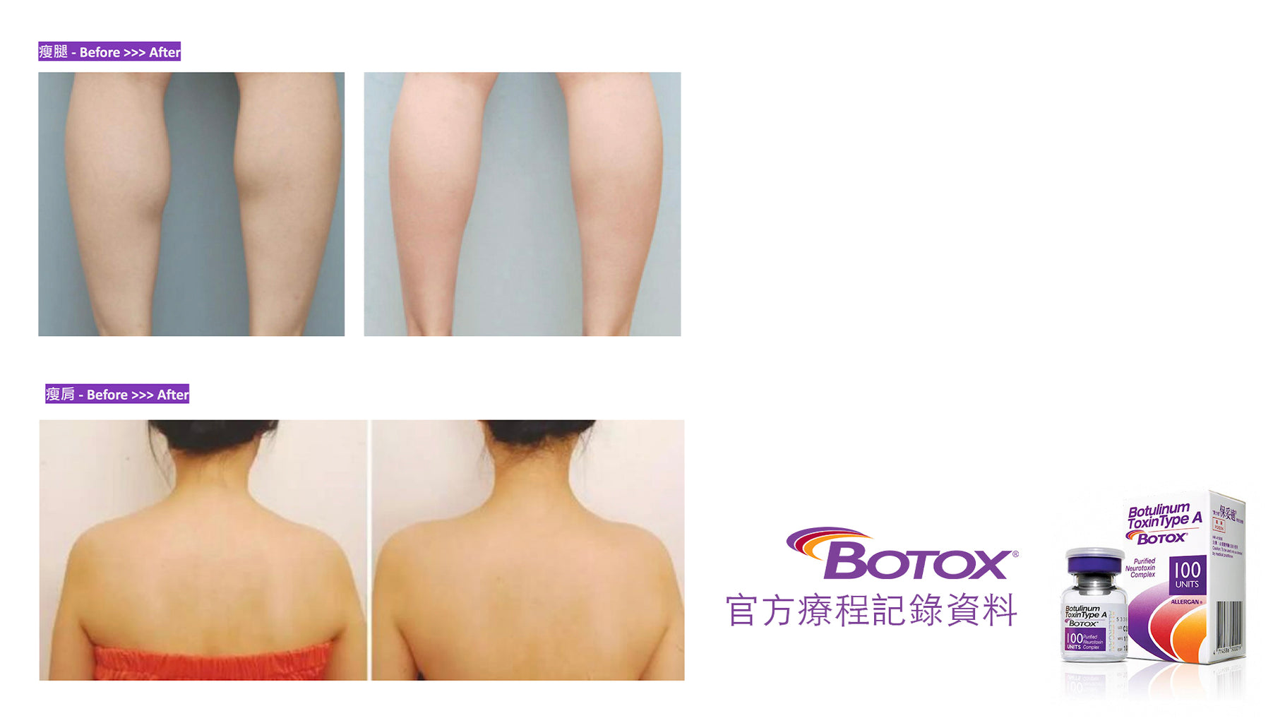 局部小腿與上背部施打 BOTOX 肉毒桿菌素的前後對照圖。上方為小腿注射區域,治療前小腿肌肉較粗壯;治療後肌肉線條放鬆,腿型更修長平滑。下方為背部注射區域,治療前背部及肩胛肌明顯;治療後曲線柔和,肌肉線條收細、皮膚表面更平整。