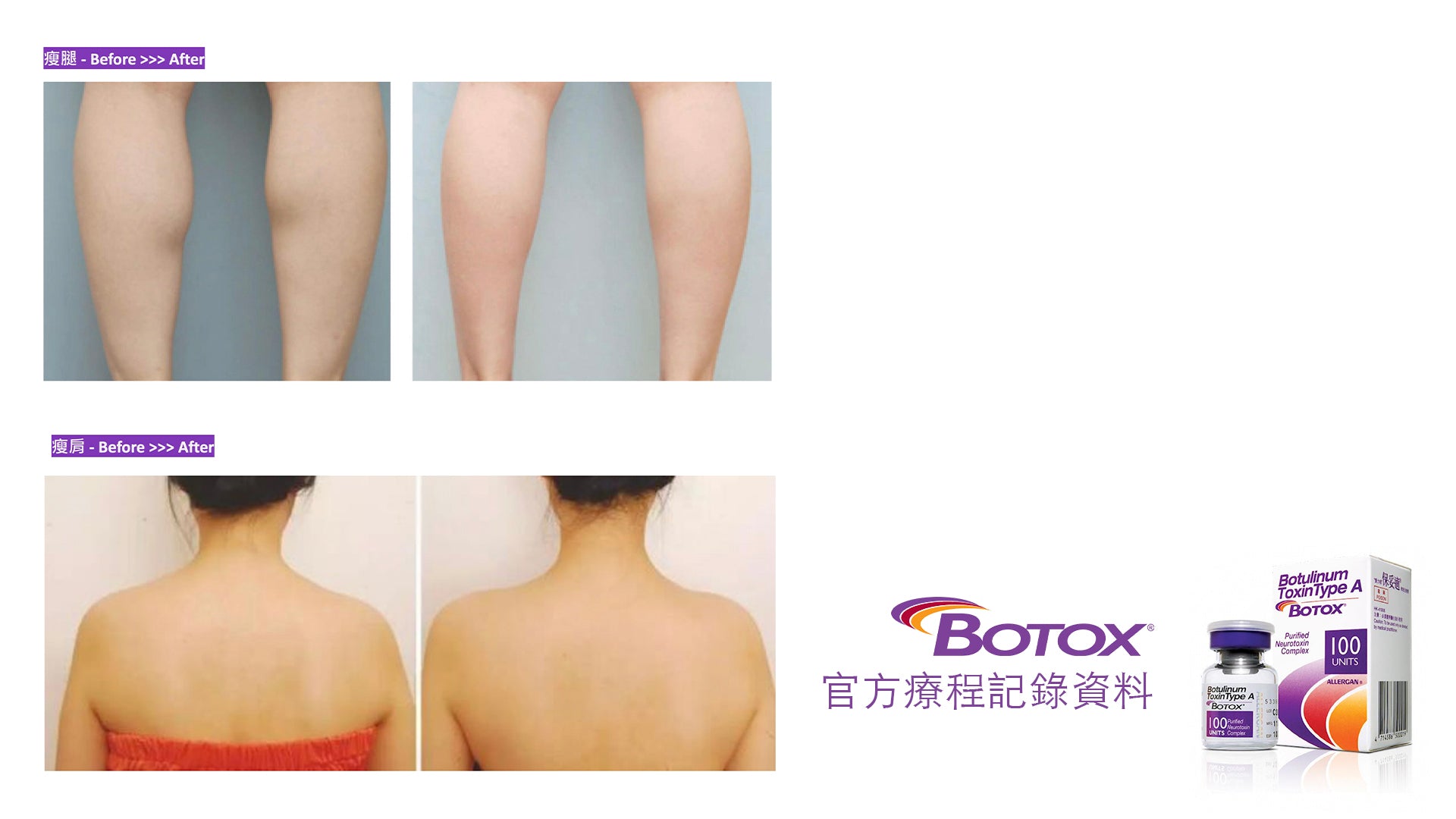 局部小腿與上背部施打 BOTOX 肉毒桿菌素的前後對照圖。上方為小腿注射區域,治療前小腿肌肉較粗壯;治療後肌肉線條放鬆,腿型更修長平滑。下方為背部注射區域,治療前背部及肩胛肌明顯;治療後曲線柔和,肌肉線條收細、皮膚表面更平整。