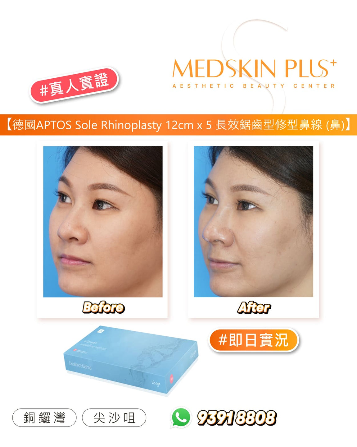 施打 APTOS 鼻專用線後即日前後對比(單次 12 cm × 5 特殊鋸齒線材)。透過微創方式將可吸收 PLA/PCL 合成線埋入鼻樑與鼻尖,利用雙向鋸齒設計穩固組織並提升鼻型輪廓。立即呈現鼻梁支撐增高、鼻尖微翹、鼻型更俐落自然。(Aptos 埋線療程帶來非手術隆鼻式成果,無需補針可維持 18–24 月效果)