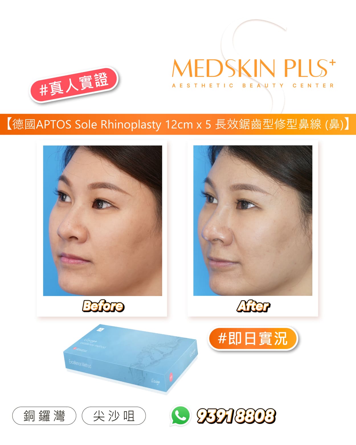 施打 APTOS 鼻專用線後即日前後對比(單次 12 cm × 5 特殊鋸齒線材)。透過微創方式將可吸收 PLA/PCL 合成線埋入鼻樑與鼻尖,利用雙向鋸齒設計穩固組織並提升鼻型輪廓。立即呈現鼻梁支撐增高、鼻尖微翹、鼻型更俐落自然。(Aptos 埋線療程帶來非手術隆鼻式成果,無需補針可維持 18–24 月效果)