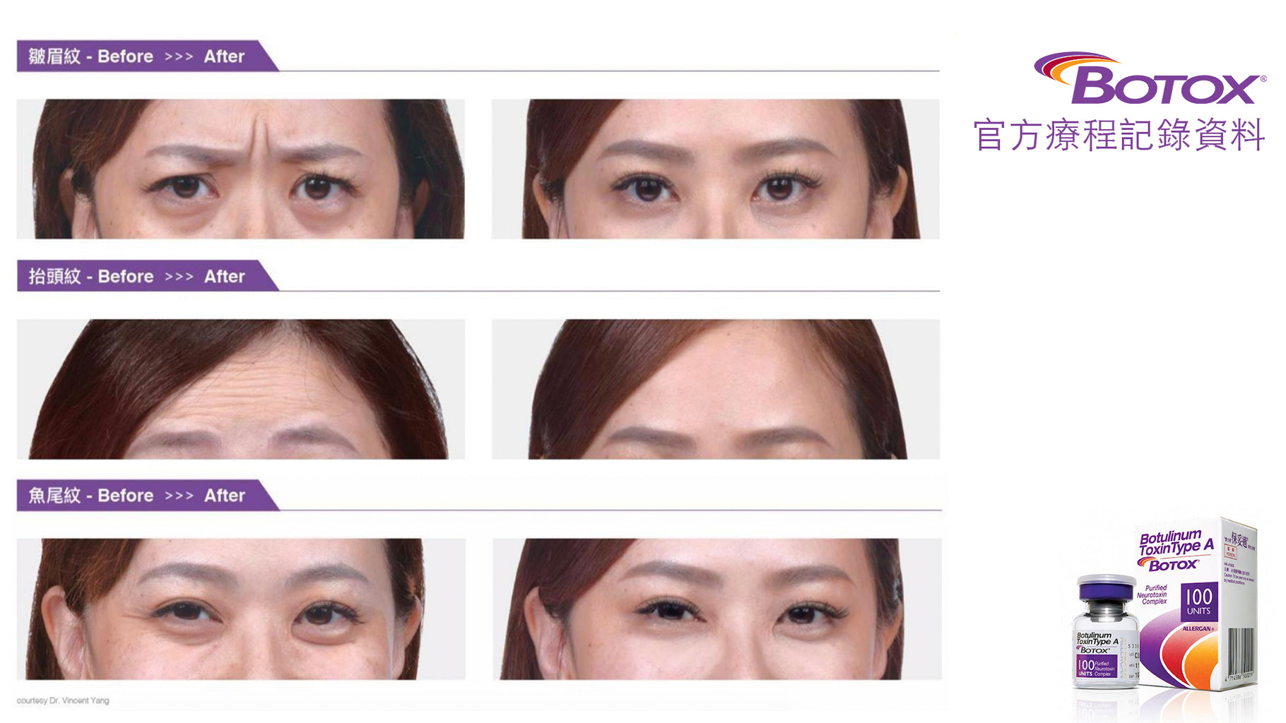 三組官方 BOTOX 治療除皺前後對照圖，從上至下分別為皺眉紋、抬頭紋與魚尾紋。每組左側為注射前，皺眉紋深刻、額頭線條明顯、眼尾睫毛紋突出；右側為注射後，表情紋顯著減淡，額頭肌肉平滑，眼尾細紋也明顯減少，整體肌膚表面更年輕平滑。