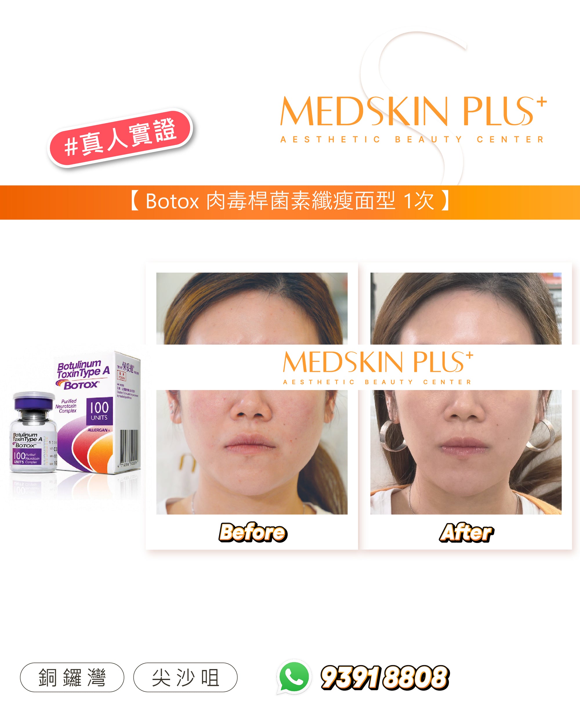 一位女性進行 BOTOX 肉毒桿菌素瘦面療程前後的比較照片。左側為治療前，臉型較圓潤，下頜線不明顯；右側為注射一次後，咀嚼肌放鬆、臉部輪廓更纖細，展現出更柔和立體的下頜線條。