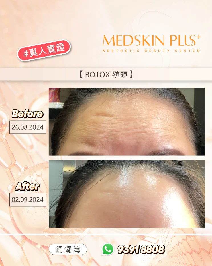 一位客人於 MEDSKIN PLUS+ 施打 BOTOX 肉毒桿菌素於額頭，上方照片拍攝於 2024 年 8 月 26 日（Before），額頭明顯佈滿水平皺紋與表情紋，皮膚質感較乾燥。 下方照片拍攝於 2024 年 9 月 2 日（After），療程後額頭紋路大幅淡化、皮膚表面光滑平整、整體膚質呈現更緊緻明亮的效果。整體改善顯著，展現 BOTOX 肉毒桿菌素在額頭除皺的可見成效與年輕化提升。