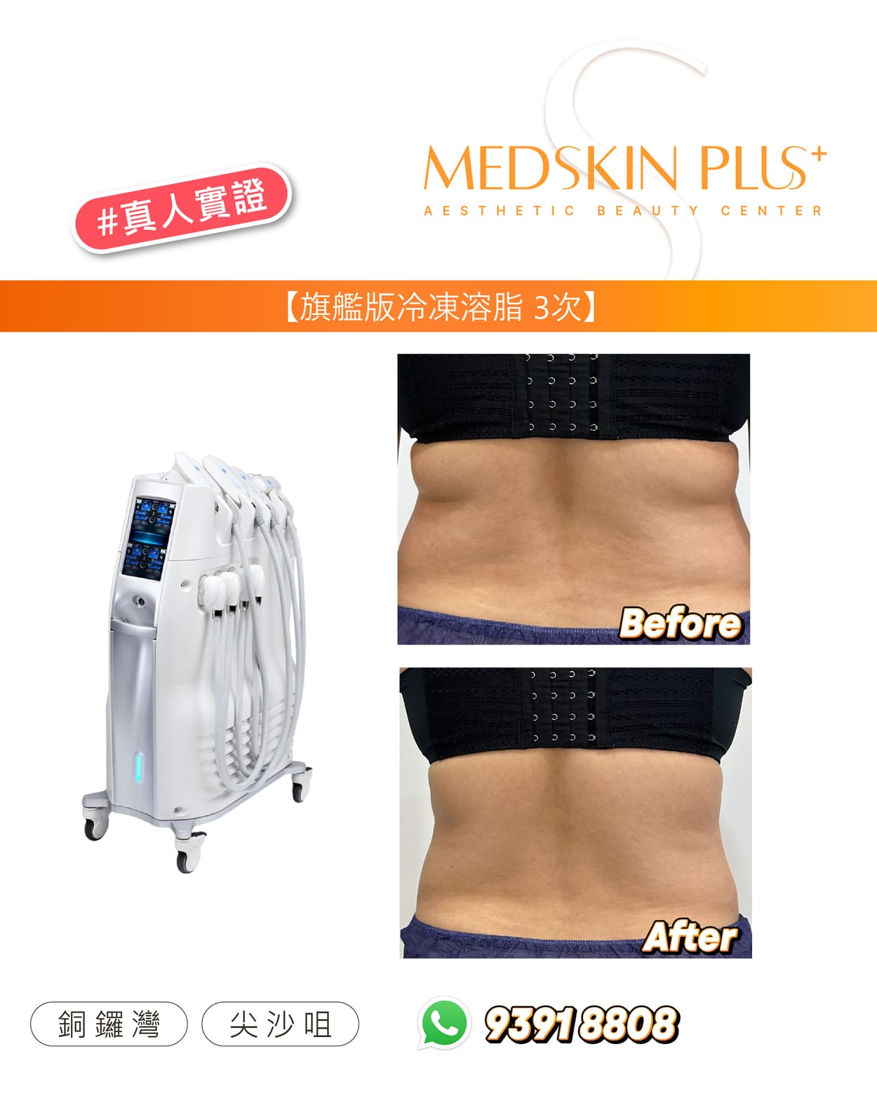 Ultimate Cryolipolysis - Cool Contouring 旗艦版冷凍溶脂：360°極致