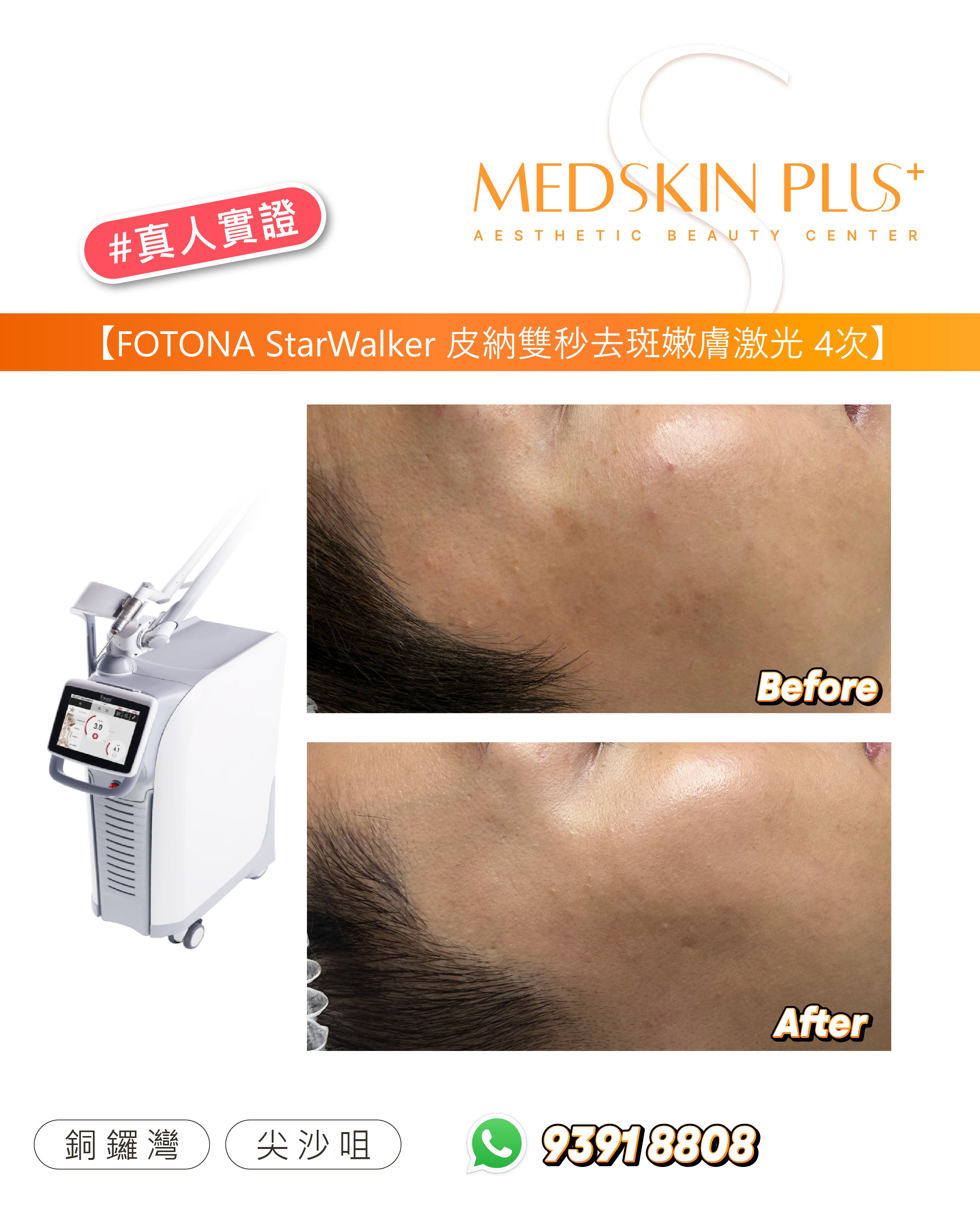Fotona Starwalker 皮納雙秒激光：高效去斑嫩膚，重現淨白無瑕