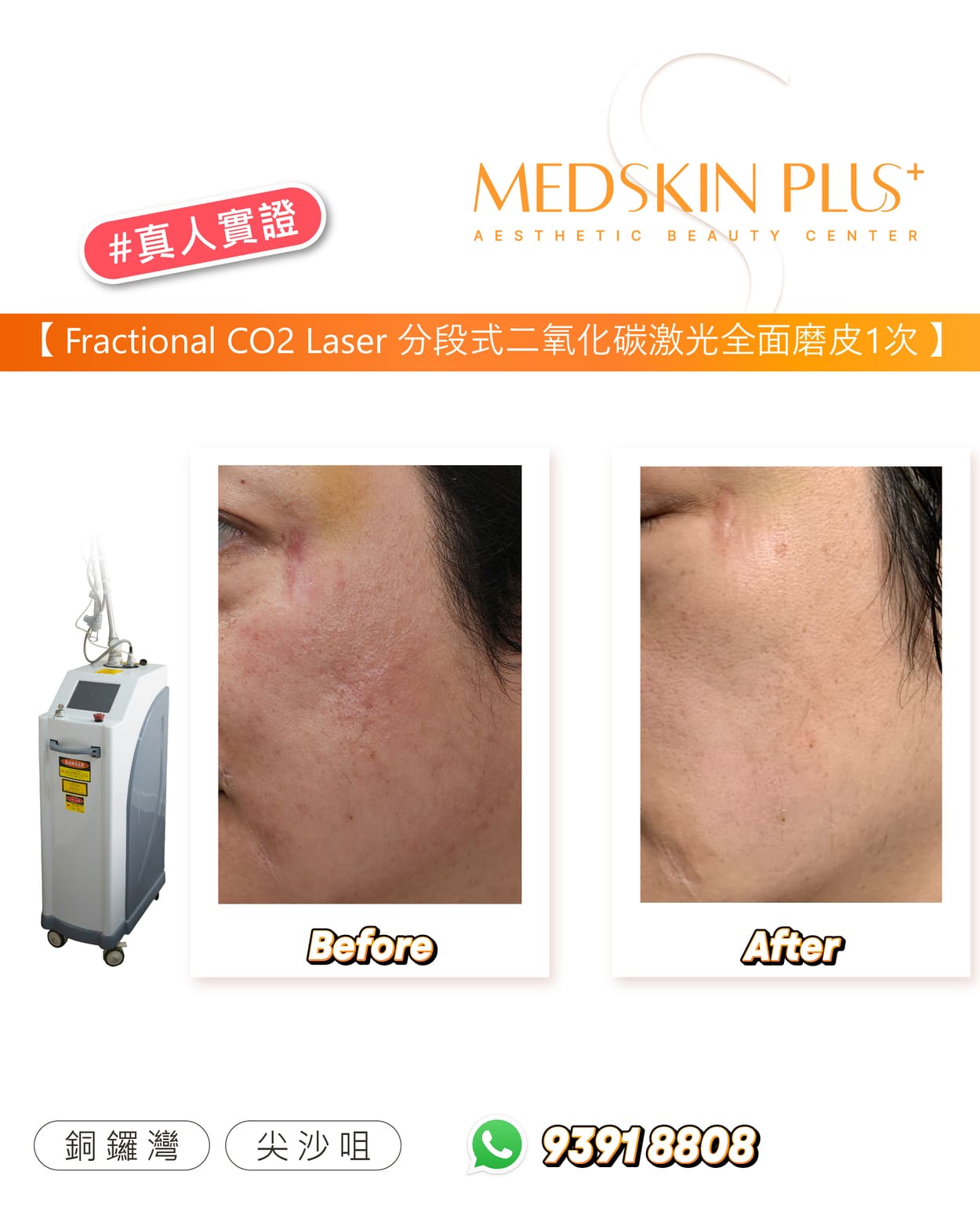  Fractional CO₂ 磨皮後皮膚即時反應：角質層老廢剝除，膚色瞬間更均勻。熱刺激有效觸發膠原蛋白與彈性纖維再生，使肌膚長期重建、回春光感。療程術後恢復快，紅腫與脫屑約於一週內消散，膚質質感逐步提升。