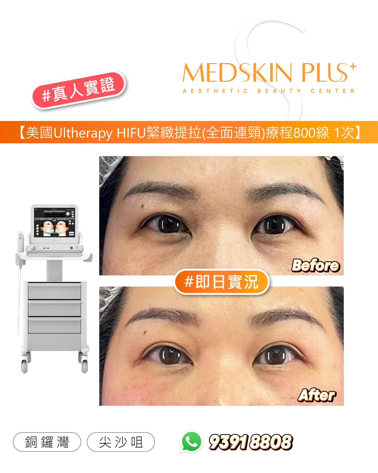 Ultherapy HIFU療程前後對比圖，左方為白色超聲波儀器，右方上下分別為女士眼部Before與即日After正面特寫，底部列出銅鑼灣及尖沙咀分店。