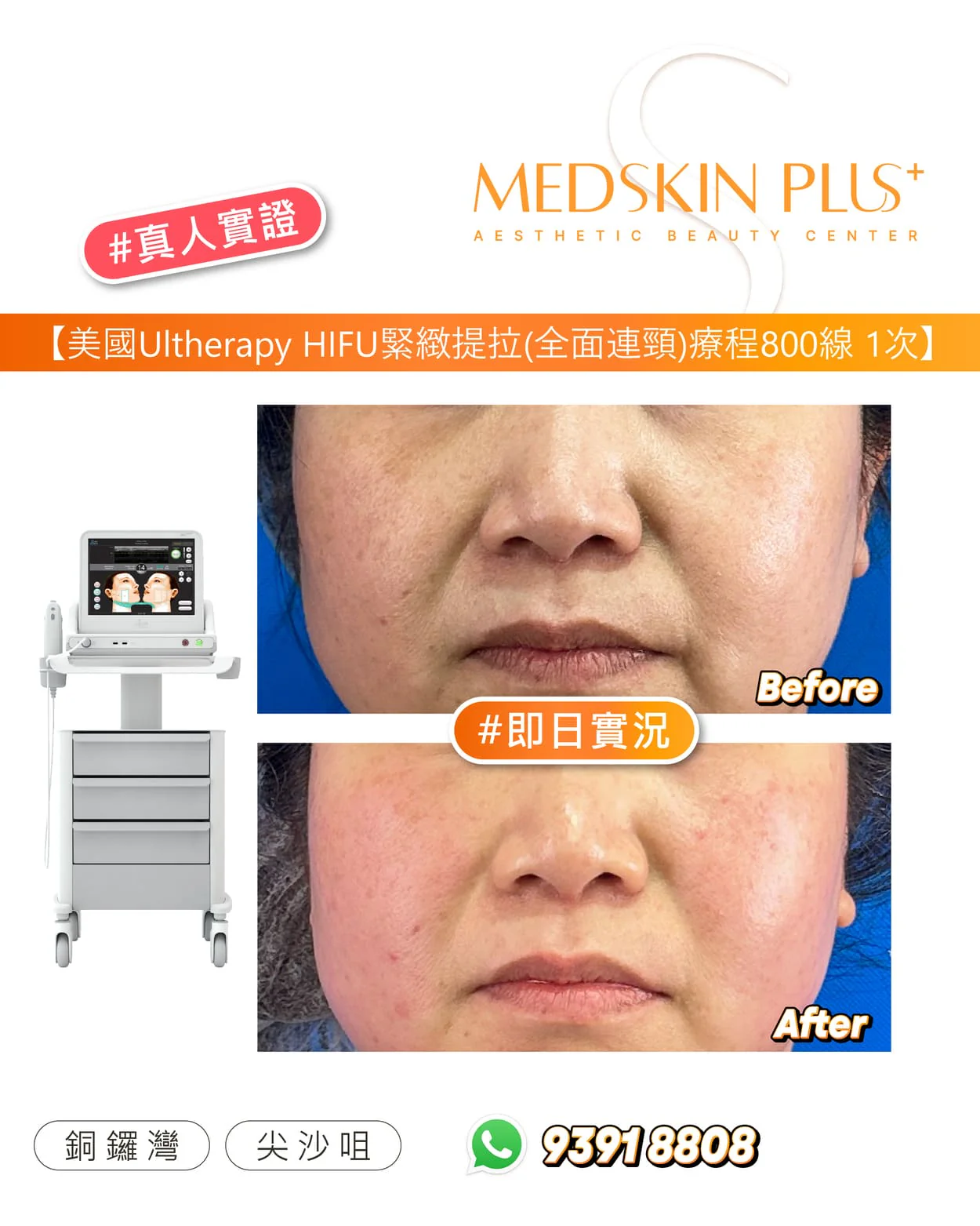 MEDSKIN PLUS+ 美國 Ultherapy HIFU 全面連頸緊緻提拉 800 線的真人面部 Before 與 After 對比圖，左側為超聲波儀器。