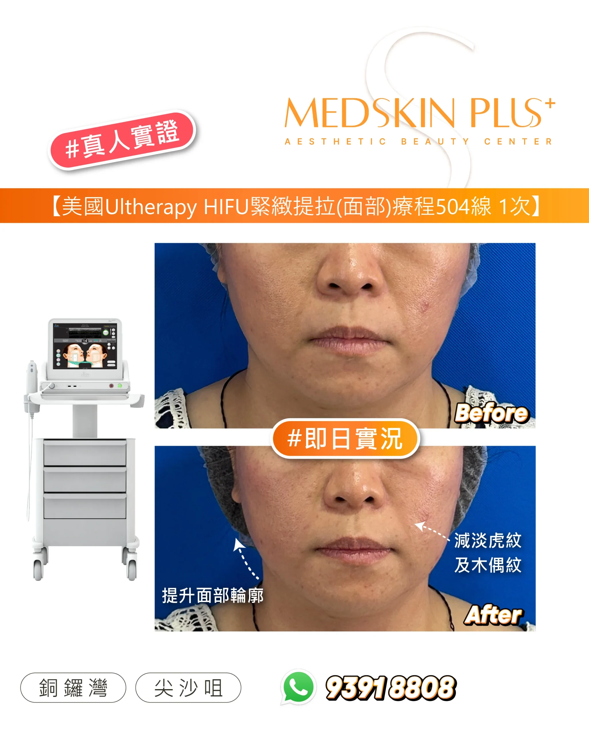 MEDSKIN PLUS+美國Ultherapy HIFU面部療程的真人實證相片，上為療程前、下為療程後，旁展示儀器主機。