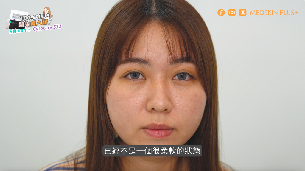麗珠蘭 rejuran 案例
