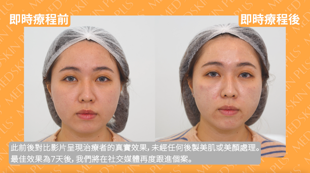 麗珠蘭 rejuran 案例前後比較