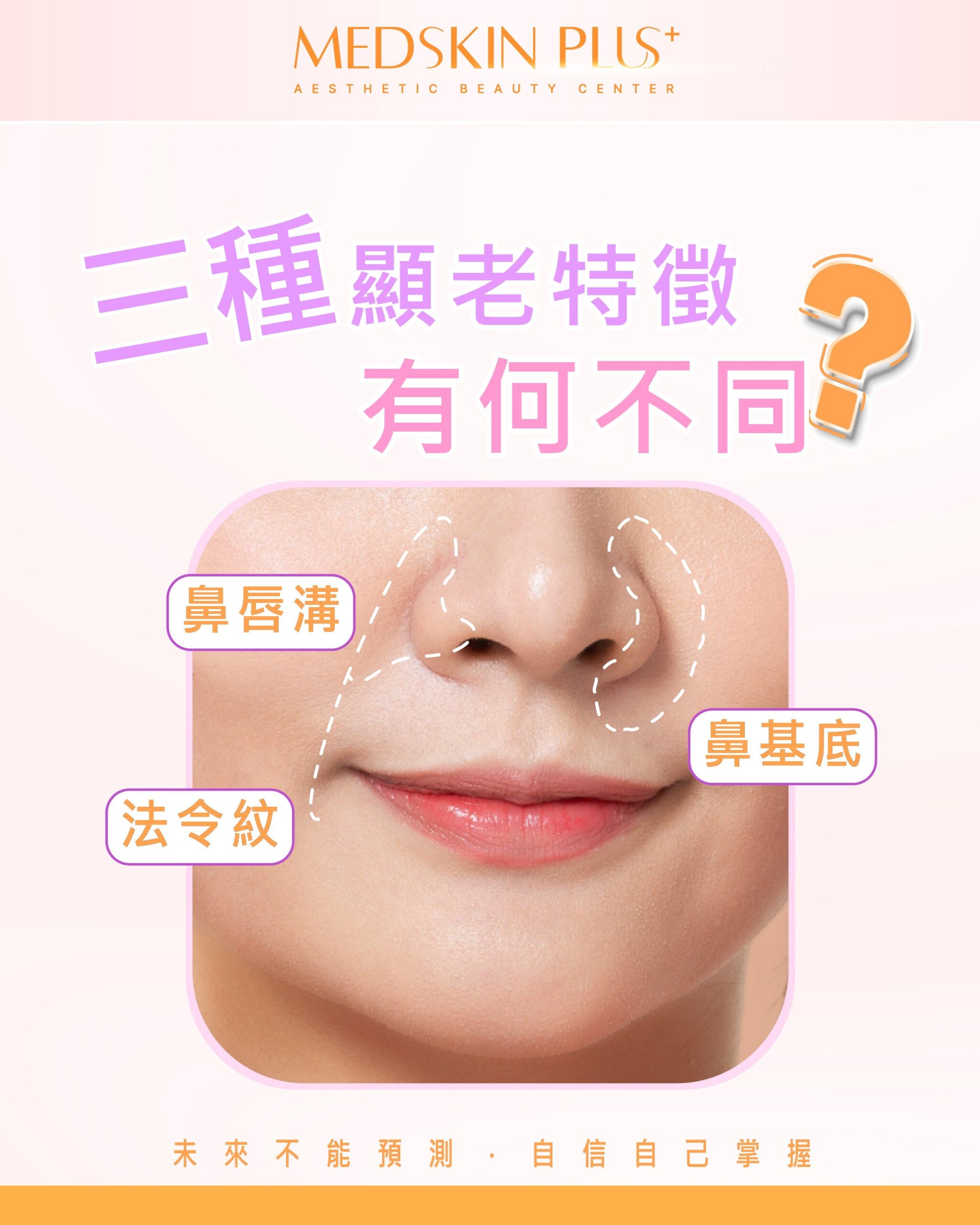 鼻基底凹陷全攻略(2025香港)：告別凹臉與法令紋，重塑立體輪廓
