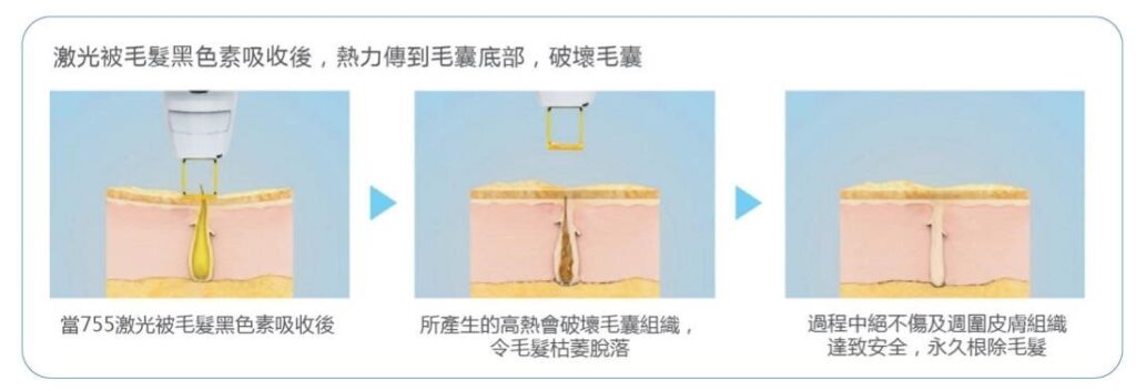 三格皮膚剖面圖解，顯示激光手掣、毛髮與毛囊結構，說明755激光被毛髮黑色素吸收後熱能傳至毛囊底部的過程