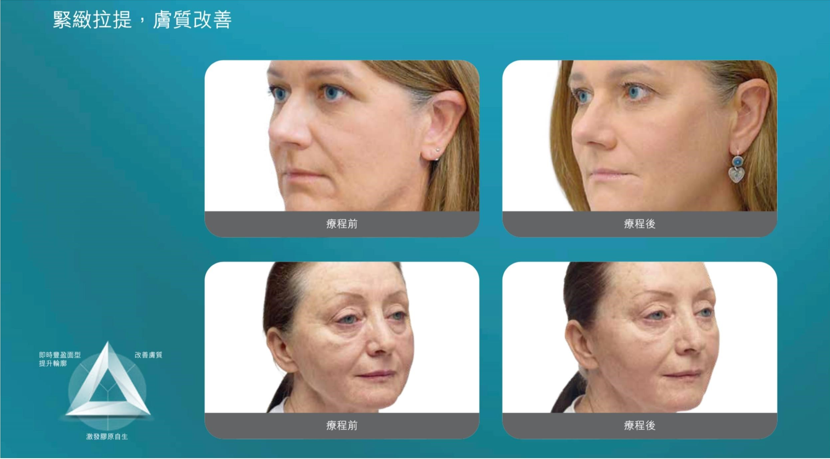 湖水綠色背景對照圖，兩組女士半側面人臉照上下並排，分別標示療程前與療程後，左側有緊緻拉提及膚質改善標題與白色三角形圖示。
