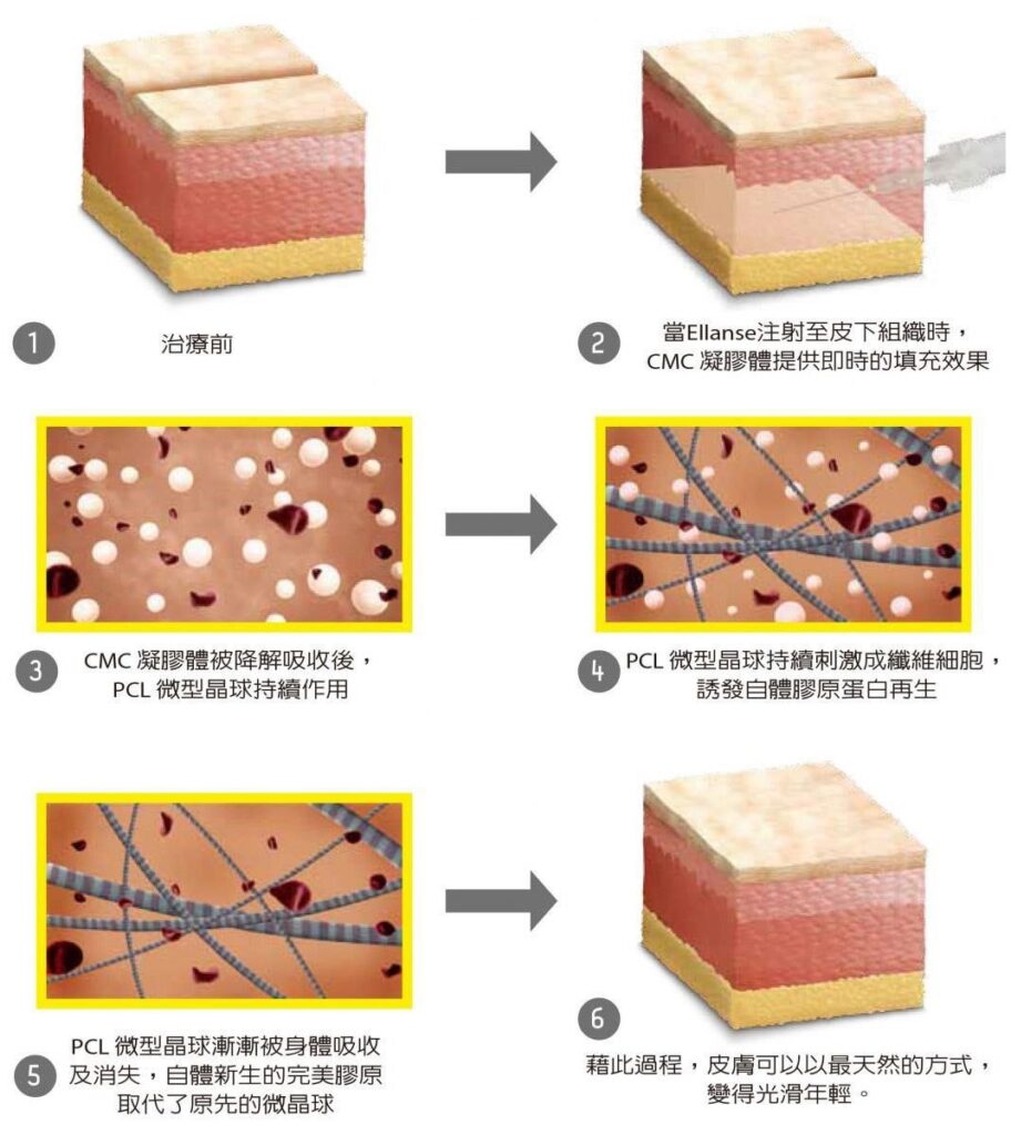 六格流程圖以皮膚橫切面模型與放大示意圖，逐步說明 ELLANSE 注射後 CMC 凝膠體與 PCL 微型晶球的變化過程。