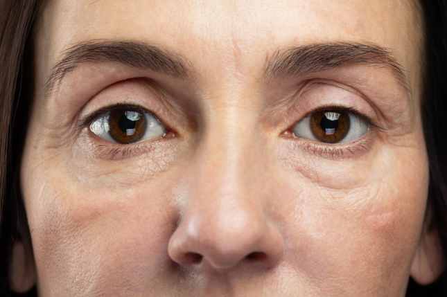 Crowsfeet eye wrinkle