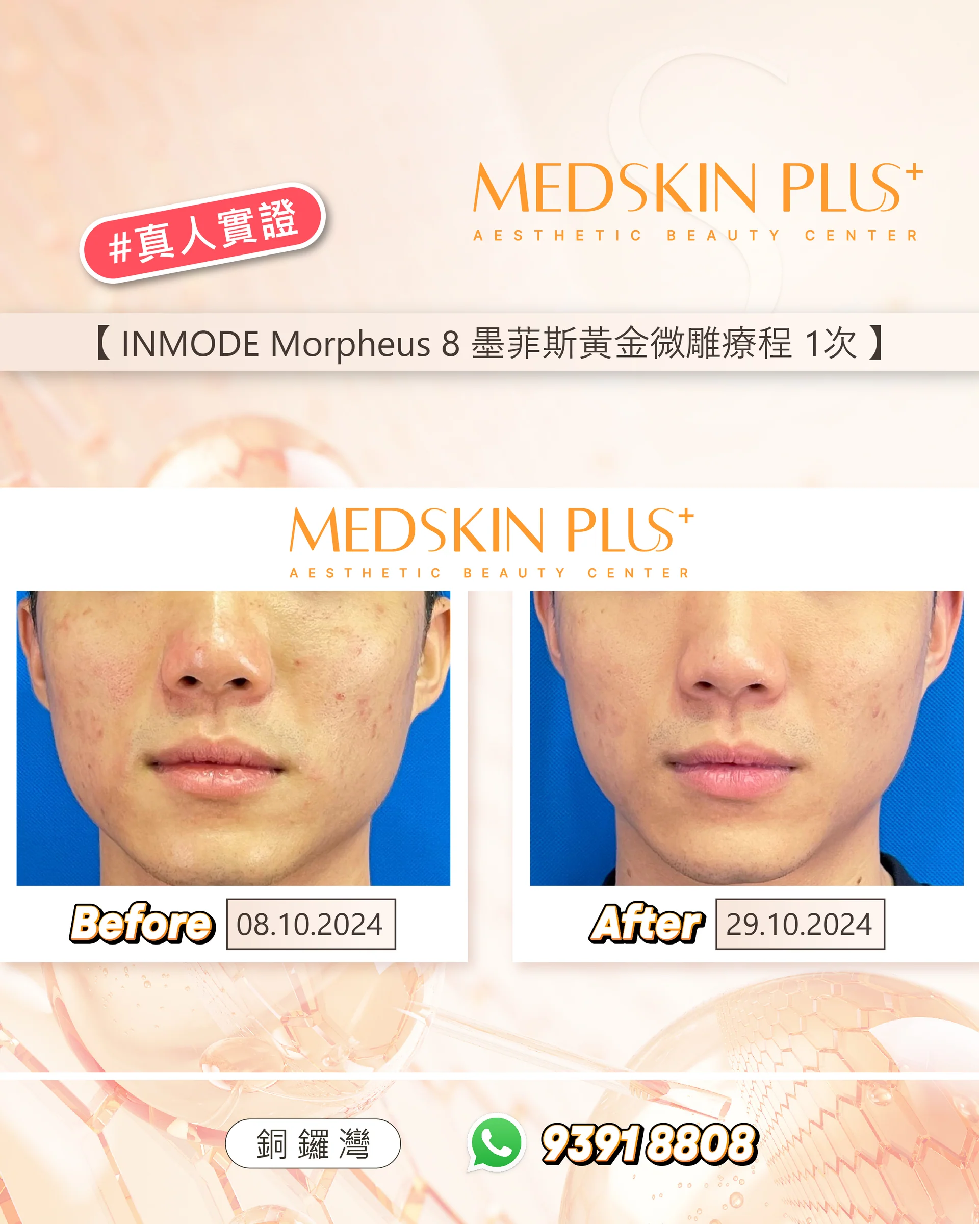 男士接受INMODE Morpheus 8墨菲斯黃金微雕療程的真人實證相片，左為2024年10月8日療程前，右為10月29日療程後。