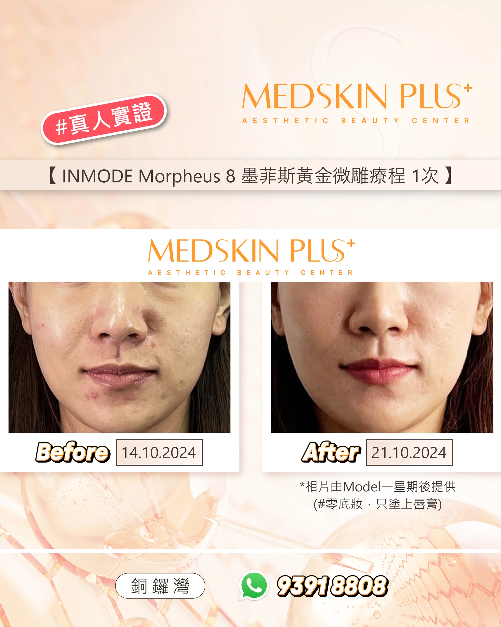 女士接受INMODE Morpheus 8墨菲斯黃金微雕療程的真人實證相片，左為10月14日療程前，右為10月21日療程後。