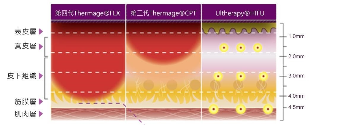 Thermage FLX 更能精準加熱膠原細胞