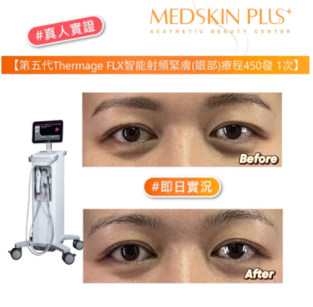 Thermage FLX 療程效果