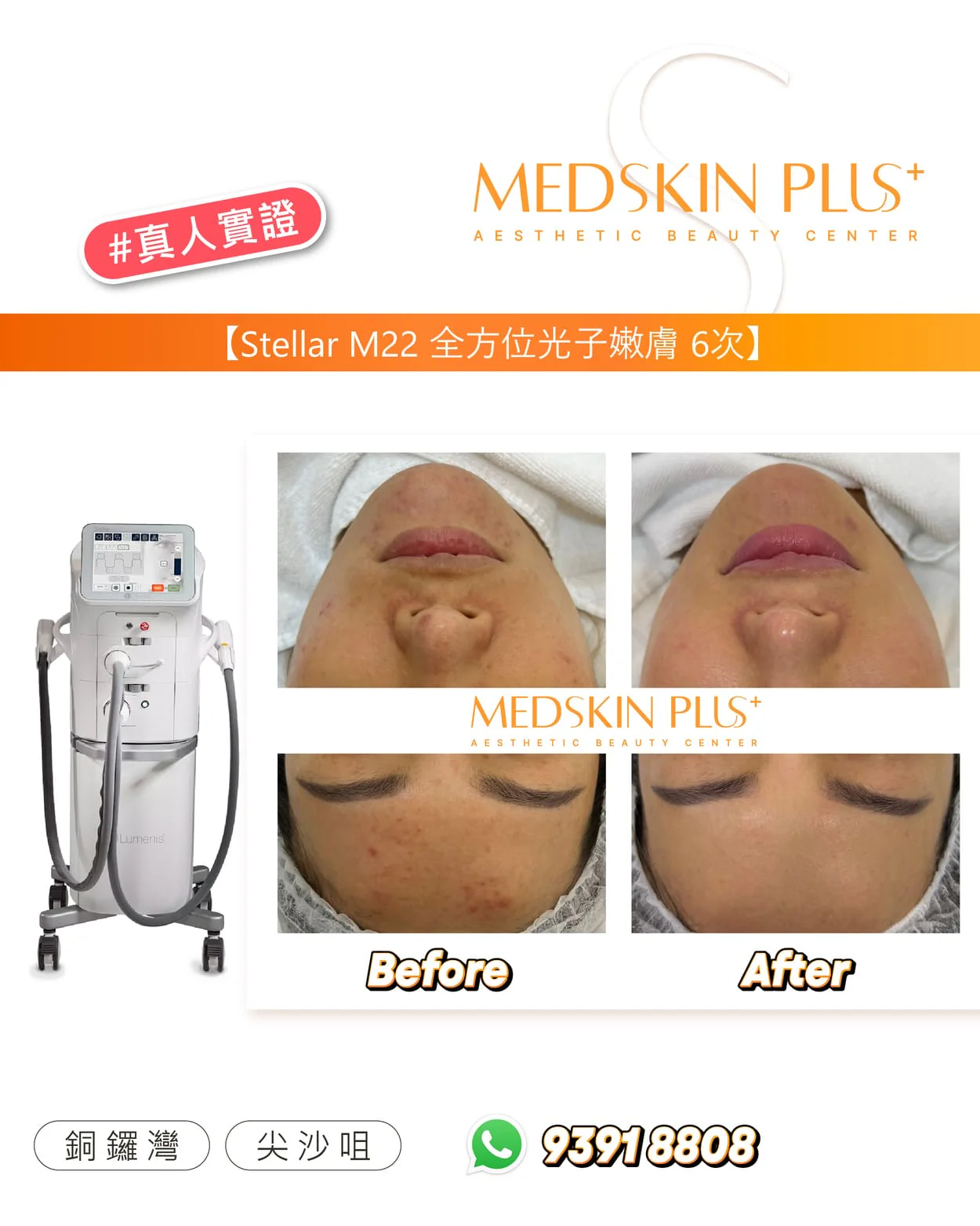 MEDSKIN PLUS+ Stellar M22 全方位光子嫩膚真人實證圖,左側為白色 M22 儀器,右側為面部 Before 與 After 特寫。