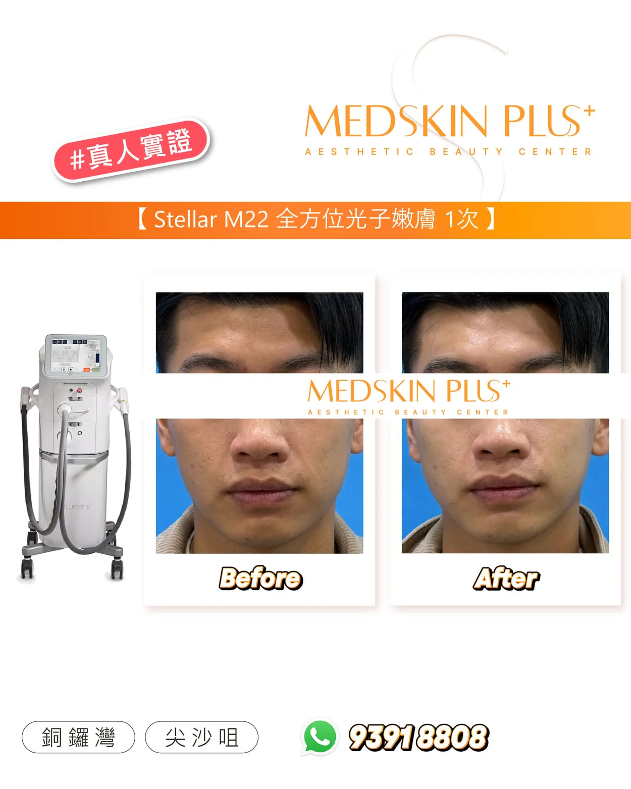 男子面部的前後對比照,左為 Before、右為 After,旁有 Stellar M22 儀器及 MEDSKIN PLUS+ 標誌。