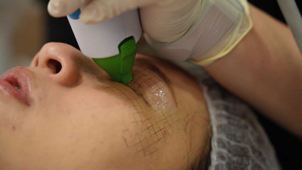 Thermage FLX 眼部療程實測：告別眼皮下垂、眼紋、眼袋，重拾年輕眼神？