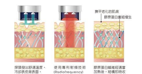 三格皮膚剖面圖，顯示探頭深入皮膚發出熱能、以專利射頻技術加熱，以及膠原蛋白纖維受熱後結構收縮。
