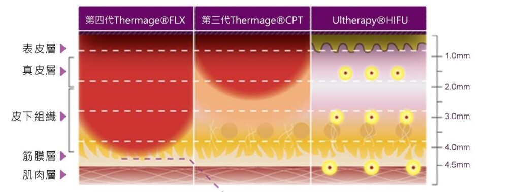 三欄式皮膚斷層圖，比較第四代Thermage FLX、第三代Thermage CPT與Ultherapy HIFU的熱能作用範圍，右側標示深度刻度
