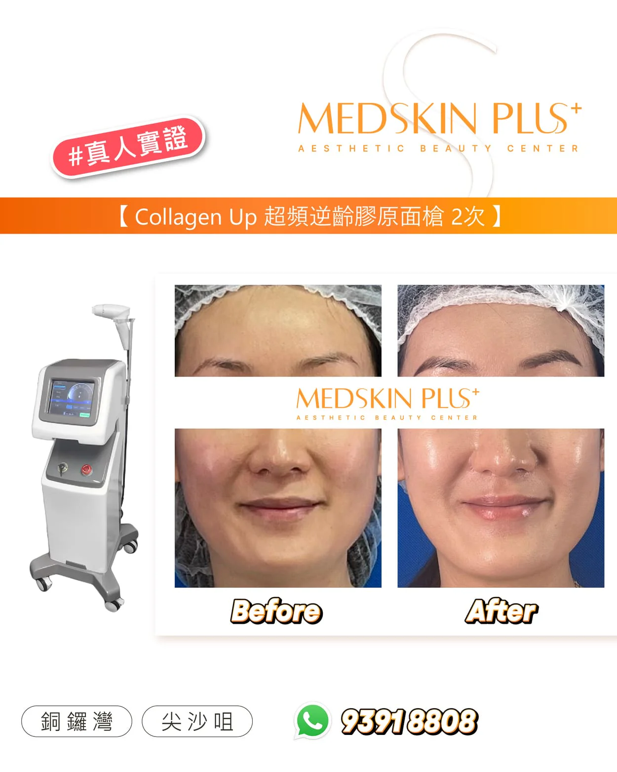 MEDSKIN PLUS+ Collagen Up 超頻逆齡療程真人實證對比圖，左側為白色膠原槍儀器，右側四格面部 Before 與 After 特寫。