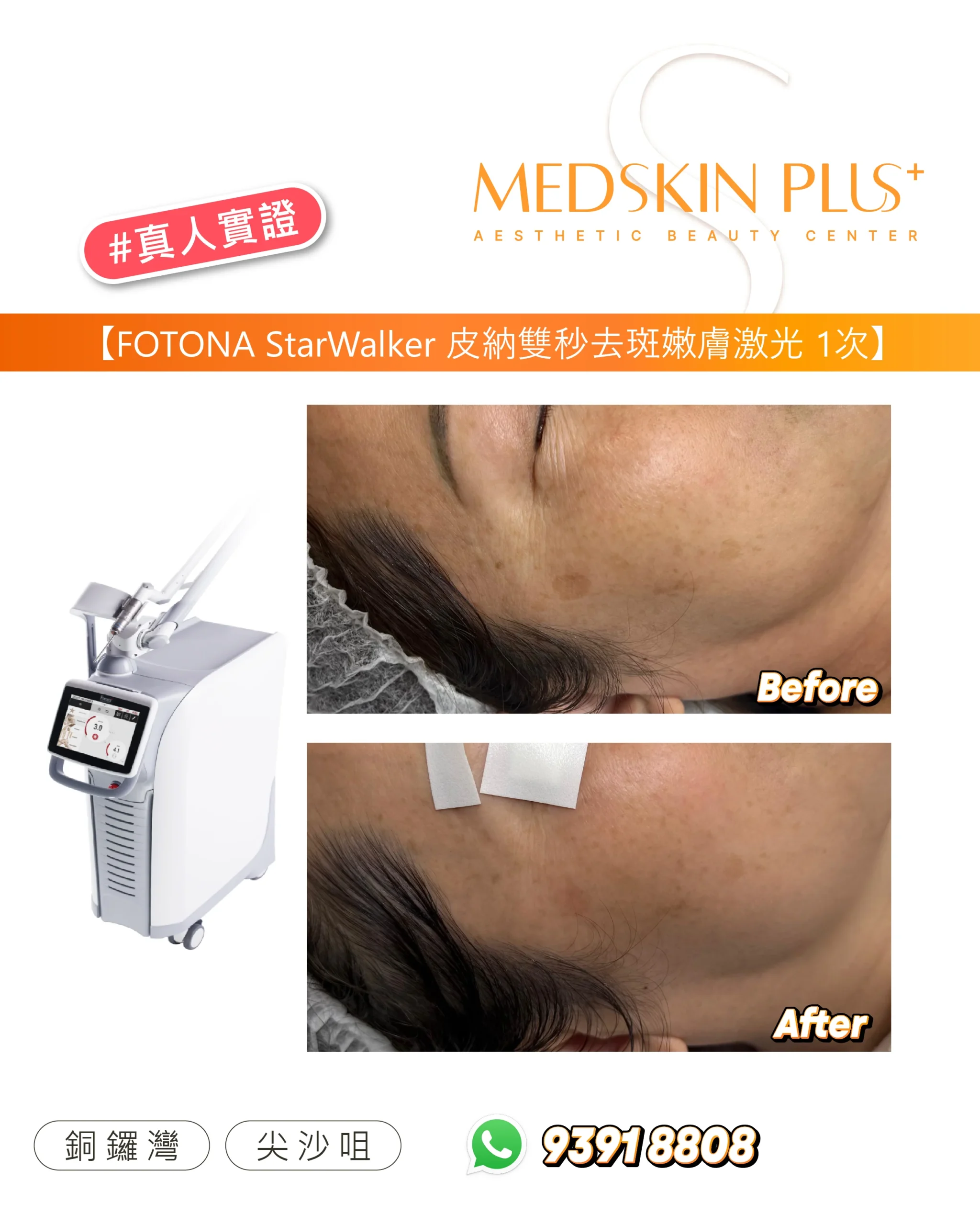 FOTONA StarWalker 去斑嫩膚激光 1 次實證圖，左為激光儀器，右為額頭及面頰 Before 與 After 特寫，After 相貼有兩片白色記號貼。