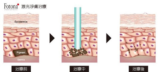 Fotona 激光淨膚治療圖解，三幅皮膚橫切面分別顯示治療前、激光光束針對色素及治療後