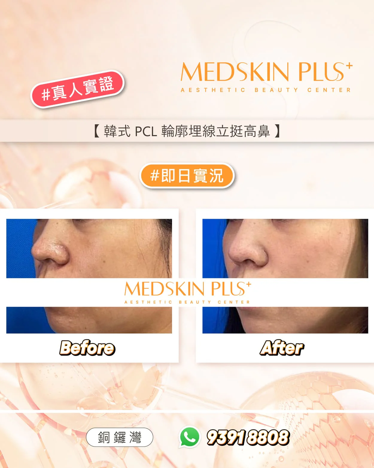 MEDSKIN PLUS+ 韓式 PCL 輪廓埋線側面鼻部 Before 與 After 對比圖，呈現即日實況紀錄。