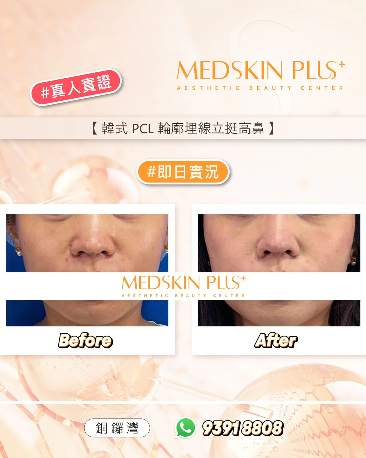 MEDSKIN PLUS+ 韓式 PCL 輪廓埋線立挺高鼻真人實證圖，以正面鼻部 Before 及 After 兩格特寫對比。