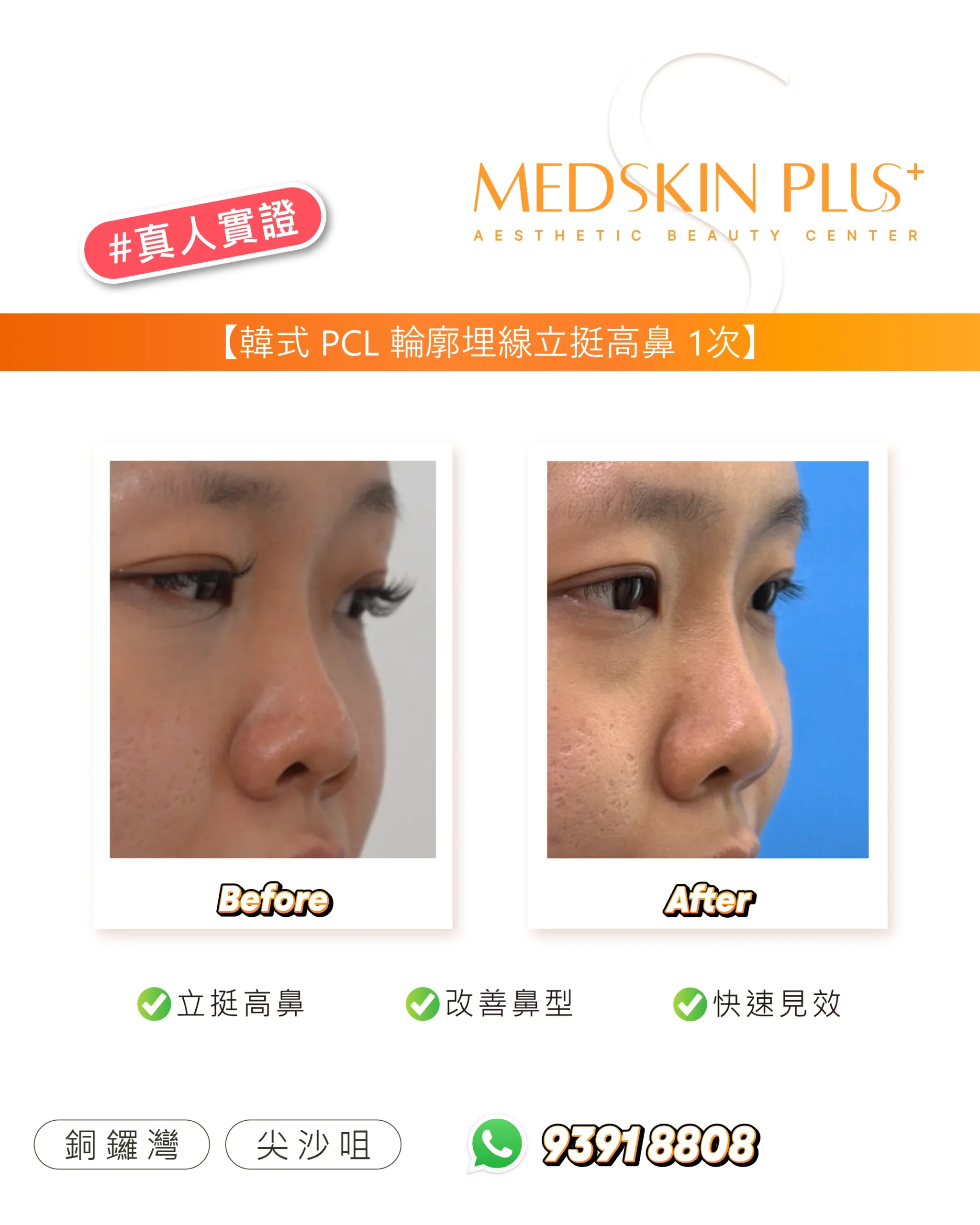 MEDSKIN PLUS+ 真人實證對比圖，左右並列同一女士側面鼻樑的 Before 與 After 特寫，下方列出項目及分店電話。