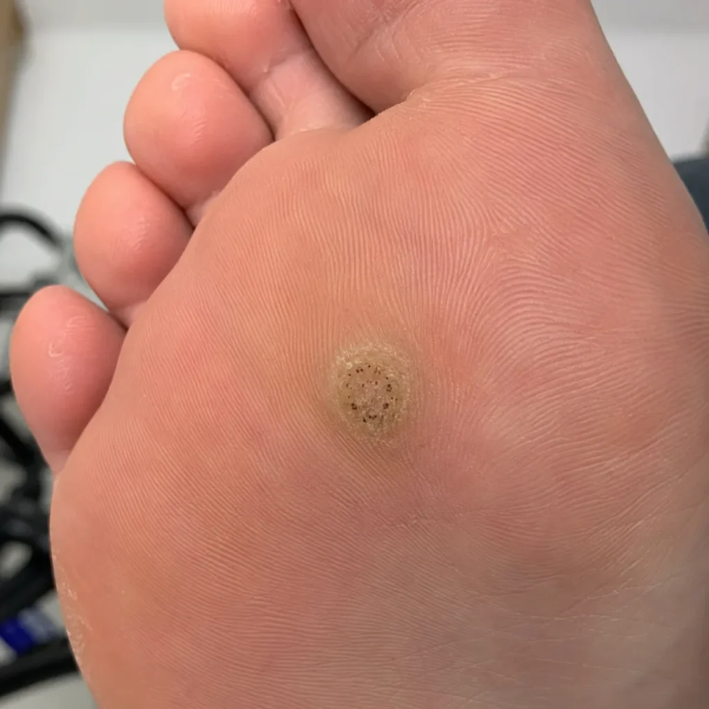 足底疣（Plantar Wart）外觀示意圖
