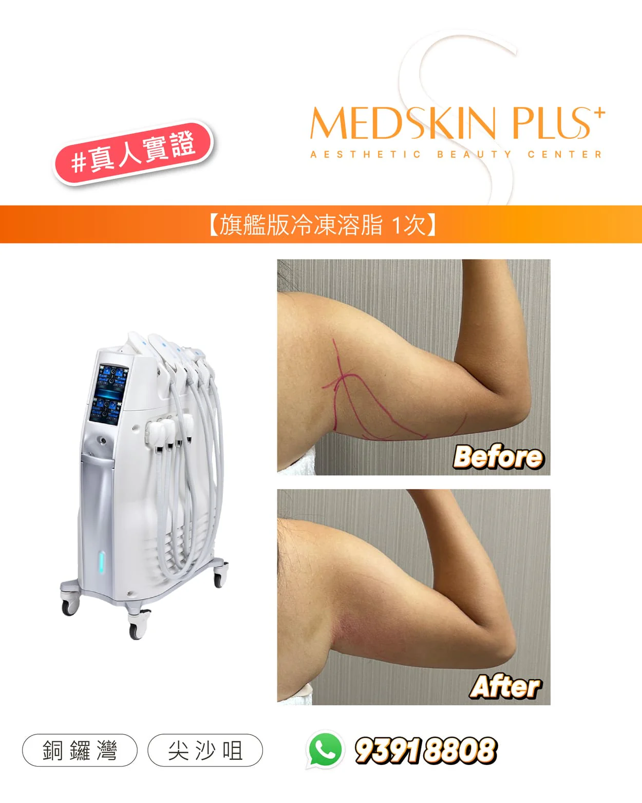 男子舉起上臂的 Before 與 After 對比照，Before 圖上以紅線標示上臂內側範圍。