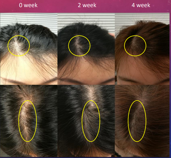 六格頭皮記錄拼圖，上排三格頂部依序標示 0 week、2 week、4 week，拍攝髮旋位置；下排三格為頭頂俯視角度，每格以黃色圓圈或橢圓框出同一處髮旋範圍。