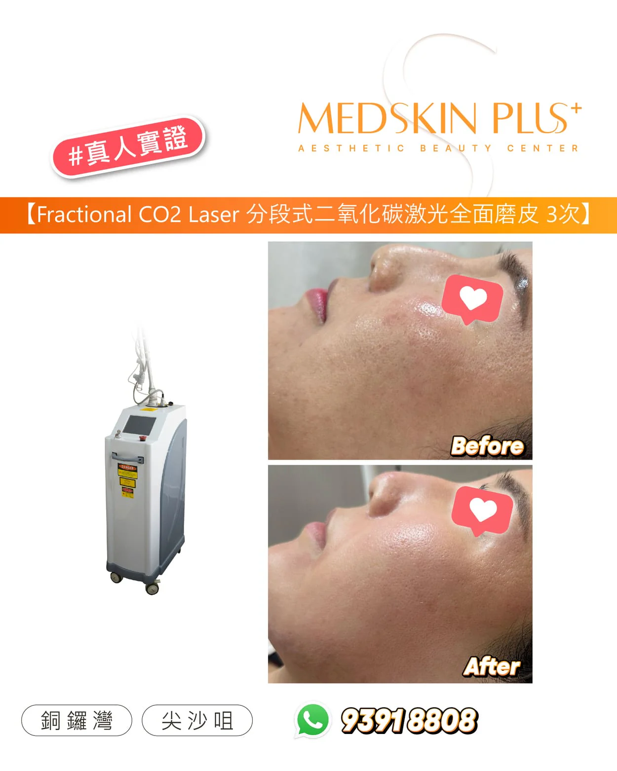MEDSKIN PLUS+ 貼文，左側是配關節臂的分段式二氧化碳激光儀器，右側為女士側面臉部 Before 與 After 對比照