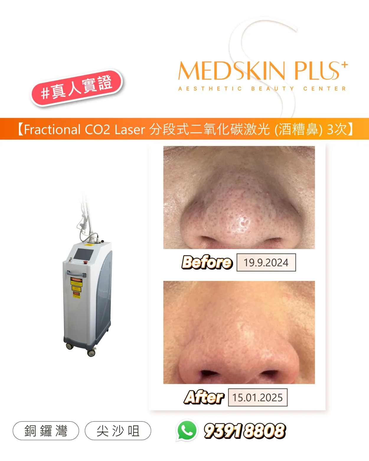 二氧化碳激光真人實證圖，左方為白色儀器，右方為女士鼻部 Before 及 After 特寫，並標註 19.9.2024 與 15.01.2025 兩個日期。