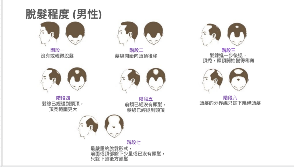 圖表標題為脫髮程度（男性），以七組側面及俯視頭部線條圖，展示由階段一沒有或輕微脫髮，至階段七只餘下頭後方頭髮的變化。
