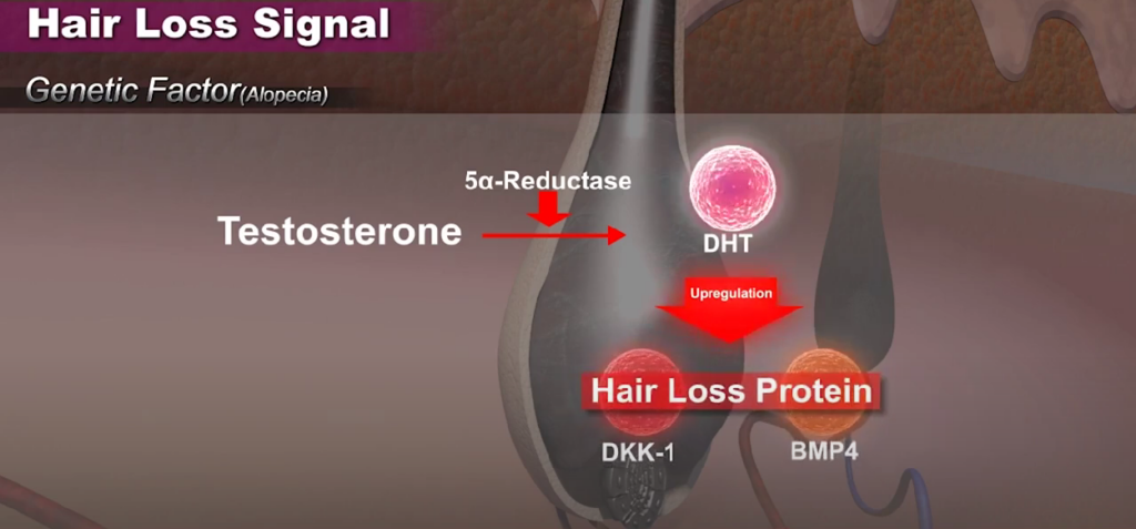 英文醫學示意圖，以皮膚及毛囊橫切面展示 Testosterone 轉化為 DHT，並上調 Hair Loss Protein、DKK-1 與 BMP4。