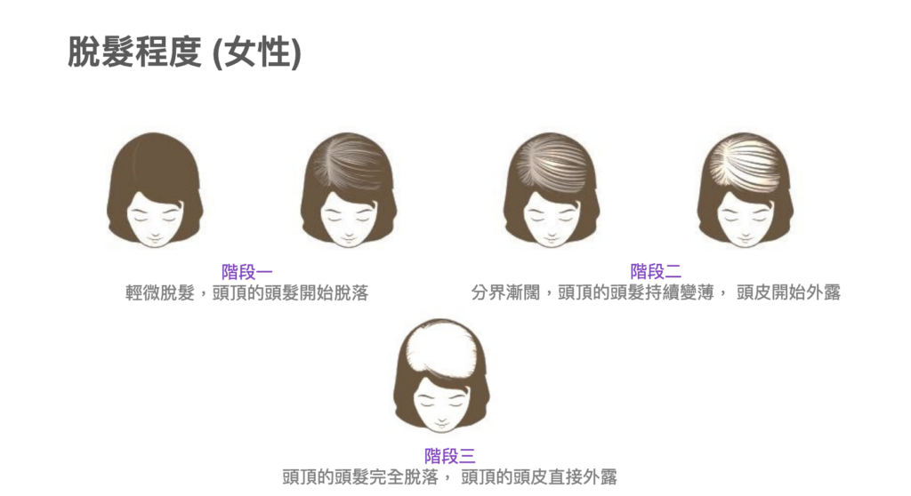 白底插畫以多個女性頭像說明脫髮程度，頭像分界由窄漸闊、頭頂髮量遞減至頭皮大範圍外露，下方標示階段一至階段三及說明文字。