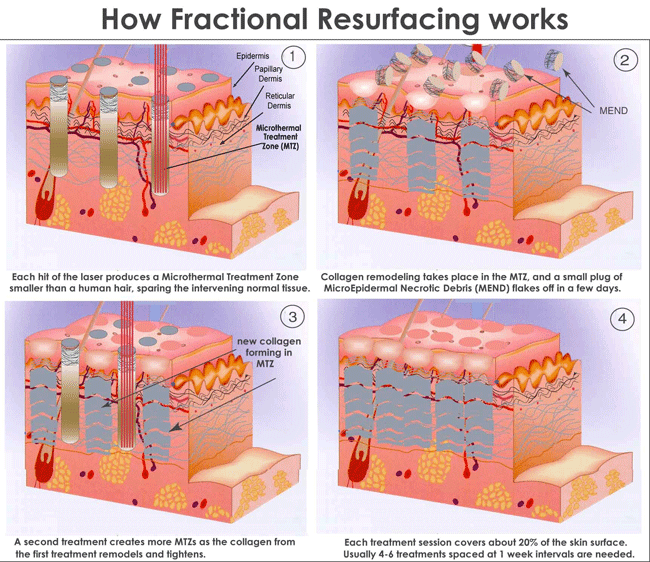 標題為 How Fractional Resurfacing works 的四格皮膚剖面圖解，標示表皮、真皮層、微熱治療區及膠原重塑過程，每格附英文說明。