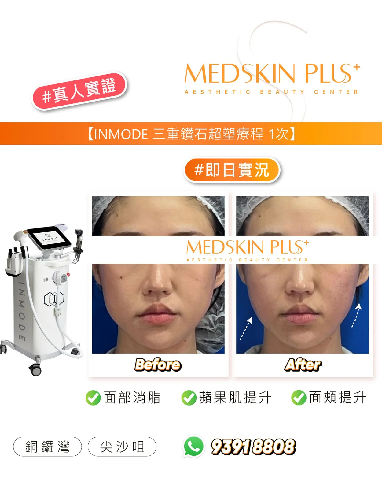 以色列 INMODE 煥肌緊緻：360°全方位回春，重塑緊緻V面 – Medskin Plus
