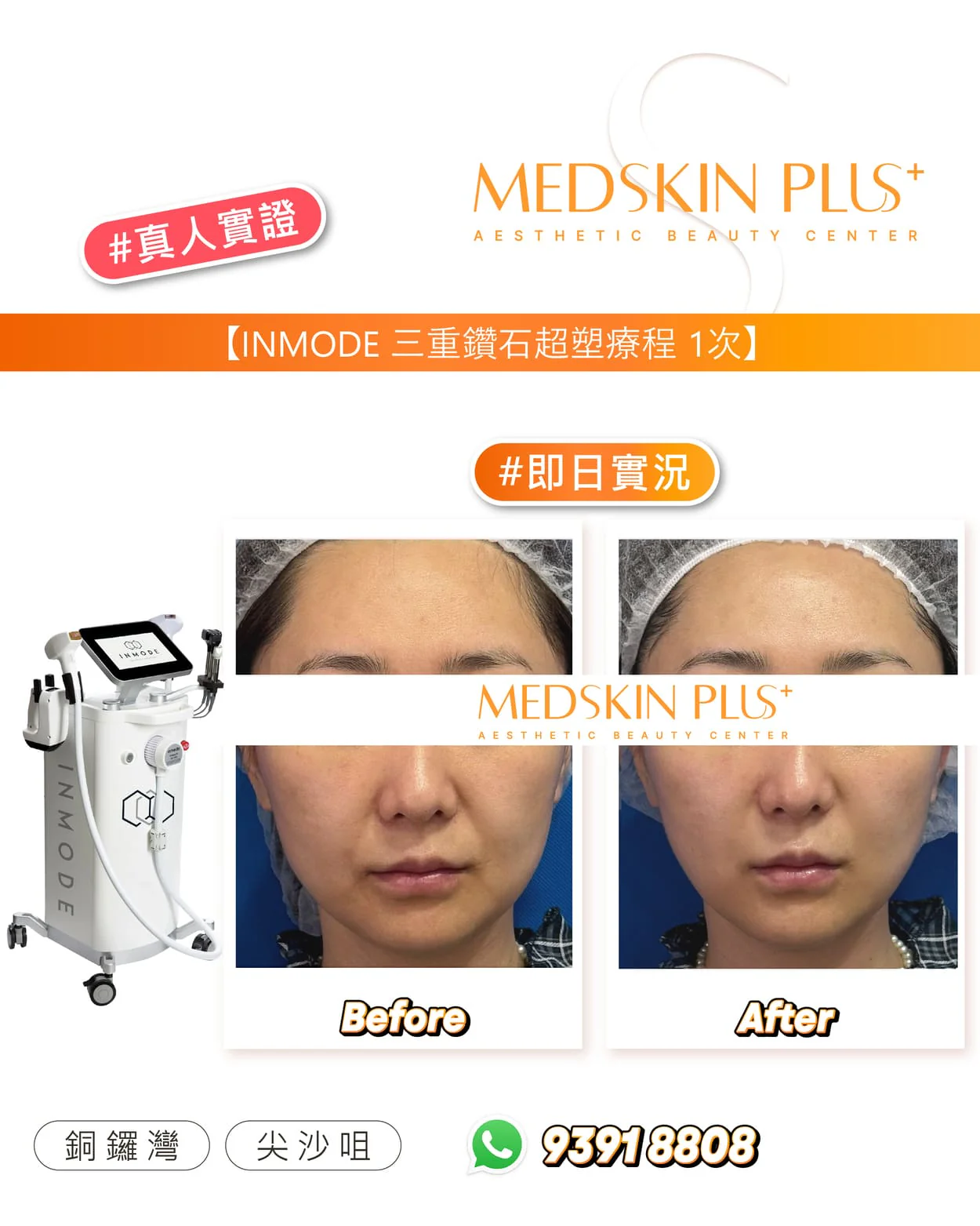 畫面左側為 INMODE 儀器，右側上方是額頭、下方是正面全臉的 Before 與 After 照片，底部標示銅鑼灣、尖沙咀及聯絡電話。