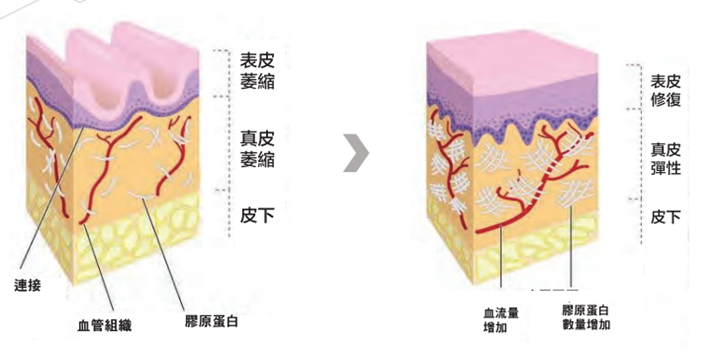 兩幅皮膚立體橫截面示意圖並列比較，左圖標示表皮萎縮、真皮萎縮、皮下、纖維、血管結構及膠原蛋白，右圖標示表皮修復、真皮彈性、皮下、血流量增加及膠原蛋白數量增加。
