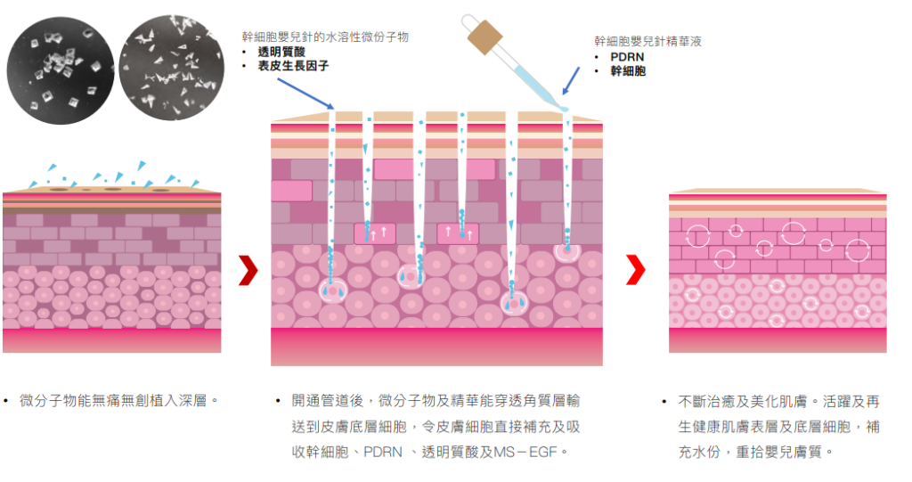 三段式皮膚結構示意圖，顯示微分子物及精華液經管道穿透角質層輸送到皮質底層細胞，左上有兩張顯微鏡下的微分子影像，各段下方附有中文說明文字