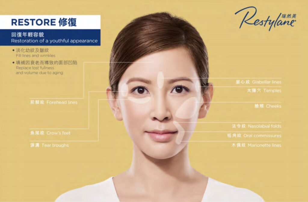 Restylane RESTORE 修復示意圖，以女士正面照標示前額紋、太陽穴、淚溝、臉頰及法令紋等位置